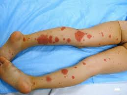 Unilateral linear capillaritis (linear pigmented purpura) Hsp Guideline Paediatric Innovation Education And Research Network