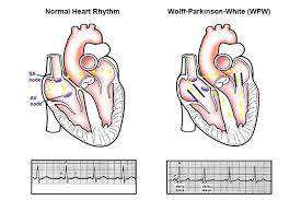 If you have wpw, you may have episodes of palpitations or rapid heartbeats. Wolff Parkinson White Syndrome Wpw Symptoms Causes