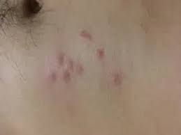 Image result for bedbugs bites