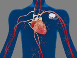 A cardiomiopatia hipertrófica ou miocardiopatia hipertrófica é uma doença do músculo cardíaco na qual uma porção. Dispositivos Cardiacos Centro Medico Cardiovascular