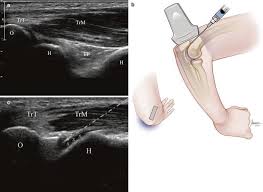 Image result for Elbow Joint Injection