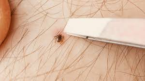 Image result for Tick Removal