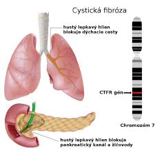 Léčba se však v posledních letech výrazně zlepšila. Cysticka Fibroza Projevy Diagnostika Prognoza Zdravovek