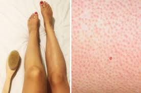 Here S Everything You Need To Know About Those Annoying Bumps On Your Arms Keratosis Pilaris Treatment Body Skin Condition And Treatment Keratosis Pilaris