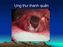 Ung thư hạ họng lời cuối của nghệ sĩ giang còi: Ung ThÆ° Thanh Quáº£n Bac SÄ© Tai MÅ©i Há»ng Ha Ná»™i