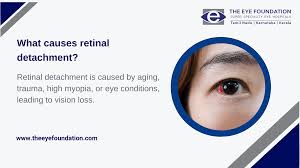 Image result for Retinal Detachment