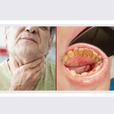 Image result for gum cancer symptoms