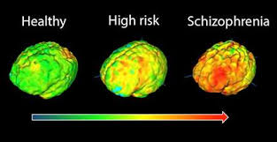 Study finds inflammation in the brain is linked to risk of schizophrenia