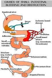 Small Bowel Obstruction Nurse Nursing Mnemonics Medical Knowledge