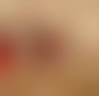 Image result for Purse String Suture