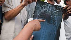 Terdapat beberapa faktor yang mendorong kepada masalah paru paru berair. 6 Tanda Paru Paru Bermasalah