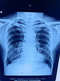 Kims Icon Doctors Remove A 25 Paisa Coin Stuck In Lungs For 30 Years Apn News