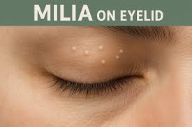 Image result for milium cyst on eyelid