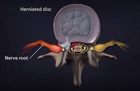 My 7 year old dachshund/terrier mix apparently just slipped a disc in his 10/11th lumbar region. The Difference Between Herniated And Bulging Discs Beacon Orthopaedics
