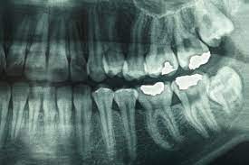 How many x rays are dangerous? How Safe Are Dental X Rays What S Involved And Why They Re Performed