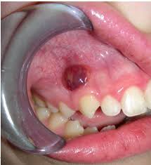 Image result for granuloma gum disease