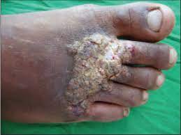 Tuberculin sensitivity is moderate to high in these patients. Cutaneous Tuberculosis Tuberculosis Verrucosa Cutis Mohanty N Nayak Bb Med J Dy Patil Univ