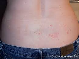 But first, here's what didn't work: Chiggers American Osteopathic College Of Dermatology Aocd