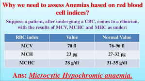 Anemia Classification Of Anaemia Hb Rbc Indicie