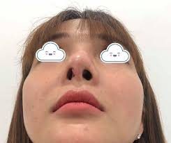 NÂNG MŨI CẤU TRÚC PHONG THỦY KHÁC GÌ VỚI NÂNG MŨI THÔNG THƯỜNG