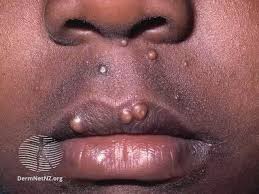 Image result for skin rash acute hiv infection