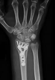Wrist injuries are often complex and consist of fracture repair, tendon and ligament repairs, fusions, stabilizing metal implants or even joint reconstruction. Distal Radius Fracture Raleigh Hand Surgery Joseph J Schreiber Md