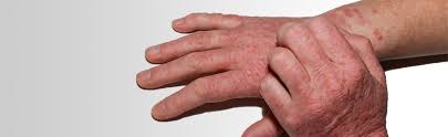 The Lesser Known Chemical Allergy From Gloves