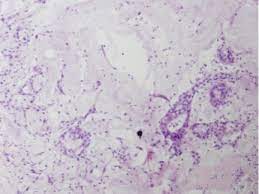 Recessed lighting installation necrotizing sialometaplasia histology. The Clinical Histologic And Treatment Spectrum In Necrotizing Sialometaplasia Oral Surgery Oral Medicine Oral Pathology And Oral Radiology