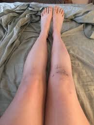 26 Days Postop Avulsion Fracture Arthroscopic Knee Surgery Knee Surgery
