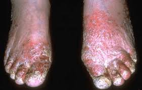 Image result for Stasis Dermatitis