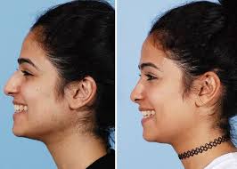 19 year old following #ClosedRhinoplasty with strut graft for tip support.  Her nose is more elegant and aesthetically balanced with her face. Happy  patient, happy surgeon! #americasbestplasticsurgeons3021 #rhinoplastyexpert  #rhinoplastybeforeandafter ...
