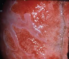 What is it and what characteristics does it have? Cervical Cancer Screening And Preinvasive Disease Oncohema Key
