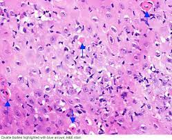 It is usually secondary to a viral. Pathology Outlines Lichenoid Esophagitis