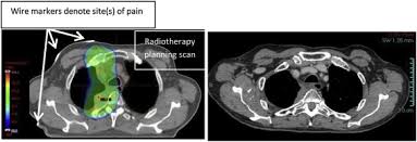 Der überwiegende anteil (> 80 %) der mesotheliome hat seinen ursprung in der pleura ( 1 ). The Role Of Radiation Treatment In Pleural Mesothelioma Highlights Of The 14th International Conference Of The International Mesothelioma Interest Group Lung Cancer