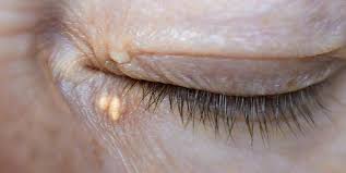 Image result for xanthelasma of eyelid