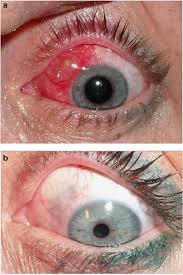 Image result for Scleritis