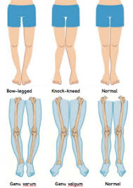 Knock Knees And Bow Legs Physiotherapy For Kids Singapore