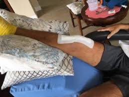 Your decision about surgery for a torn meniscus will depend on where the tear is located, the pattern of the tear, and how big it is. Wedge Pillow For Knee Replacement Surgery Knee Replacement Knee Replacement Surgery Knee Surgery Recovery