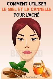 Comment Utiliser Le Miel Et La Cannelle Pour L Acne Acne Soins De La Peau Naturels Acnee