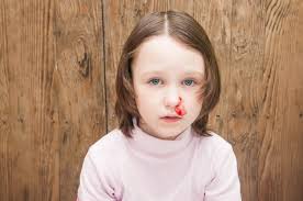 Nosebleeds In Children Ask Dr Sears The Trusted Resource For Parents