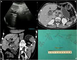 However, it is not legal in all states. Acute Obstructive Cholangitis Due To Fishbone In The Common Bile Duct A Case Report And Review Of The Literature Bmc Gastroenterology Full Text