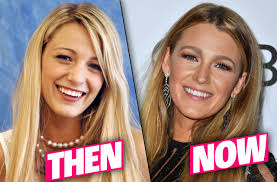Blake Livelys Nose Job Rumors-- Secret High School Photos Uncovered