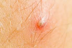 Causes of ingrown pubic hair 18 Ways To Get Rid Of Ingrown Hair At Home