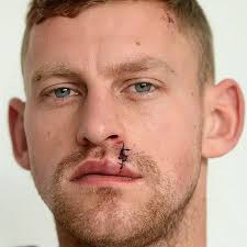 FC United keeper David Carnell left covered in blood after savage awards  night beating