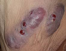From wikipedia, the free encyclopedia purpura fulminans is an acute, often fatal, thrombotic disorder which manifests as blood spots, bruising and discolouration of the skin resulting from coagulation in small blood vessels within the skin and rapidly leads to skin necrosis and disseminated intravascular coagulation. Hidradenitis Suppurativa Wikipedia