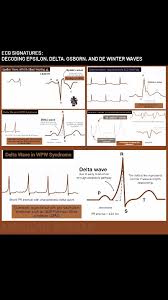 Image result for Epsilon Wave