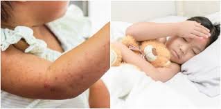 Mandi air hangat akan membuat tubuh orang dewasa yang demam menjadi lebih nyaman. Campak Pada Bayi Boleh Dijangkiti Ini Perkara Penting Ibu Perlu Buat