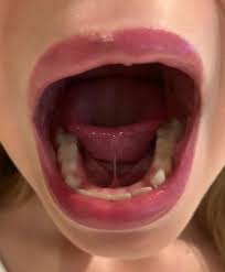 Frenillo Lingual Corto Que Puedo Hacer Clinica Fuensalud