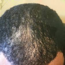 Anyways, i lost zero hair and as normal for me, my hair grew faster (facial hair was much fuller) while on cycle. Prp For Hair Loss Reviews Was It Worth It Realself