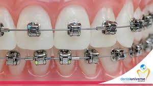 Jenis gigi yg harus di behel. Bolehkah Memasang Kawat Gigi Pada Gigi Palsu Dental Universe Indonesia
